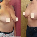 Breast Lift (Mastopexy) Before & After Patient #12879