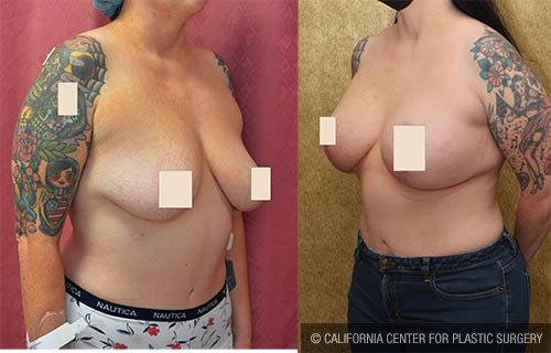 Breast Lift (Mastopexy) Before & After Patient #12879