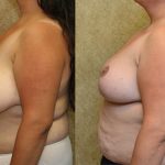 Breast Reduction Before & After Patient #12881