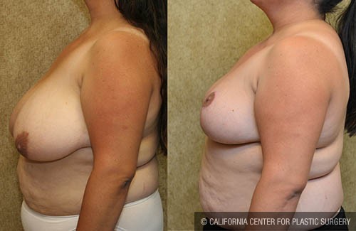 Breast Reduction Before & After Patient #12881