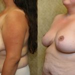 Breast Reduction Before & After Patient #12881