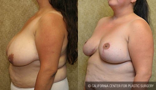 Breast Reduction Before & After Patient #12881