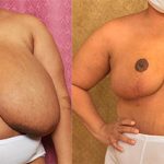 Breast Enhancement Before and After Photos Encino - Plastic Surgery Gallery  Glendale - Dr. Sean Younai