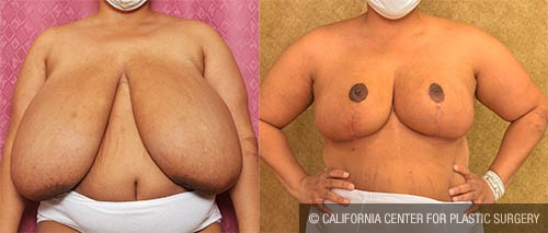 Breast Reduction Before & After Patient #12753