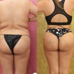 Buttock Lift/Augmentation Before & After Patient #12761