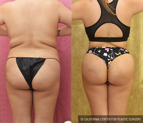 Buttock Lift/Augmentation Before & After Patient #12761