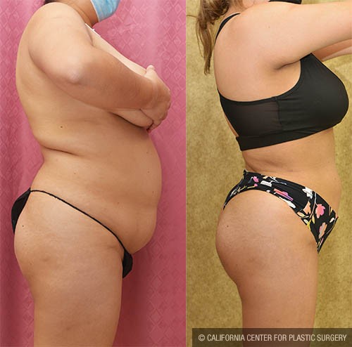 Buttock Lift/Augmentation Before & After Patient #12882