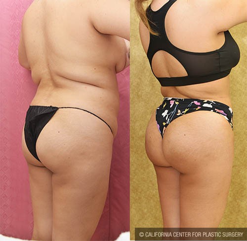 Buttock Lift/Augmentation Before & After Patient #12761