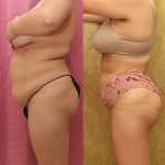 Buttock Lift/Augmentation Before & After Patient #12764