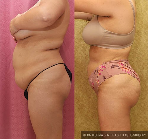 Buttock Lift/Augmentation Before & After Patient #12764