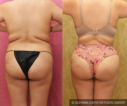 Buttock Lift/Augmentation Before & After Patient #12764