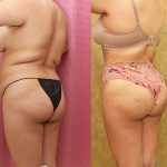 Buttock Lift/Augmentation Before & After Patient #12764