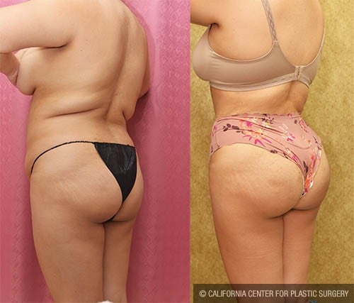 Buttock Lift/Augmentation Before & After Patient #12764