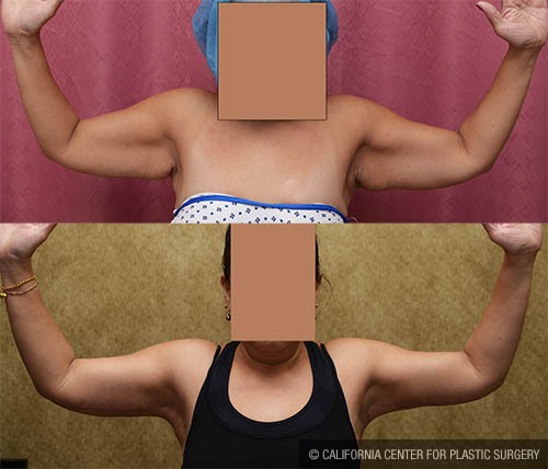Arm Lift (Brachioplasty) Before & After Patient #12756