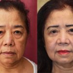 Asian Eyelid Surgery (Blepharoplasty) Before & After Patient #12777