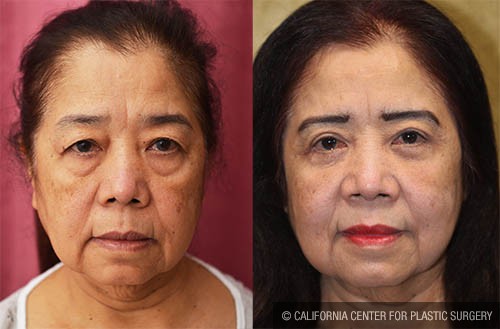 Asian Eyelid Surgery (Blepharoplasty) Before & After Patient #12777