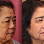 Asian Eyelid Surgery (Blepharoplasty) Before & After Patient #12777