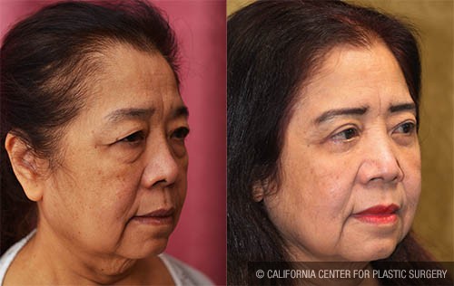 Asian Eyelid Surgery (Blepharoplasty) Before & After Patient #12777