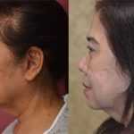 Asian Eyelid Surgery (Blepharoplasty) Before & After Patient #12777