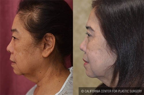 Asian Eyelid Surgery (Blepharoplasty) Before & After Patient #12777