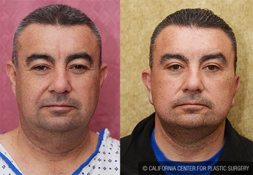 Facelift Before & After Patient #12783