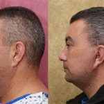 Facelift Before & After Patient #12783