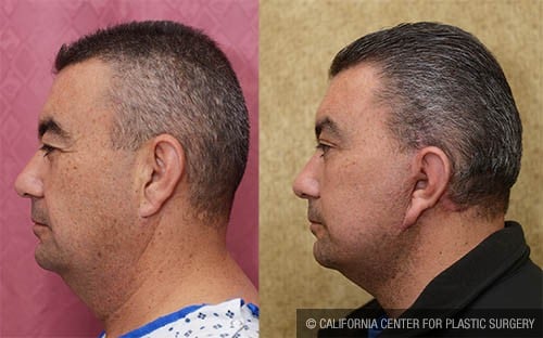 Facelift Before & After Patient #12783