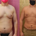 Male gynecomastia (breast) reduction Before & After Patient #12805