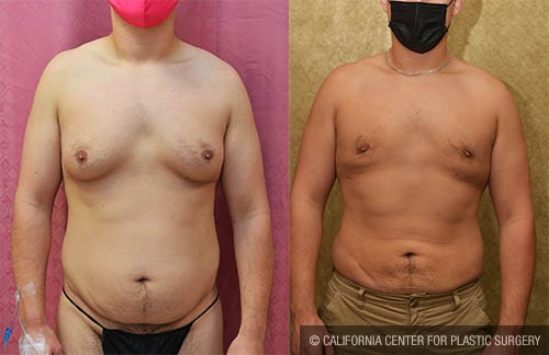 Male gynecomastia (breast) reduction Before & After Patient #12805