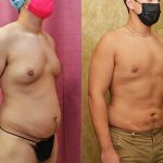 Male gynecomastia (breast) reduction Before & After Patient #12805