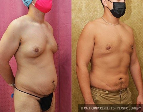 Male gynecomastia (breast) reduction Before & After Patient #12805