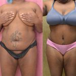 Tummy Tuck (Abdominoplasty) Medium Size Before & After Patient #12854