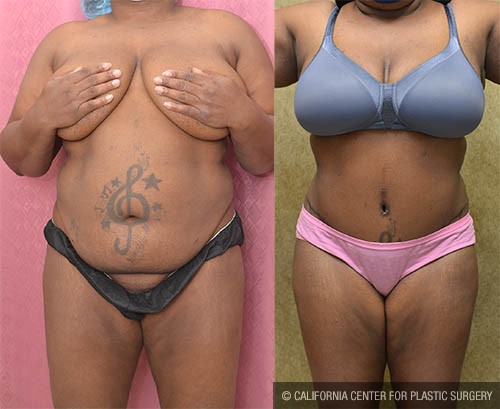 Tummy Tuck (Abdominoplasty) Medium Size Before & After Patient #12854