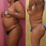 Tummy Tuck (Abdominoplasty) Small Size Before & After Patient #12842