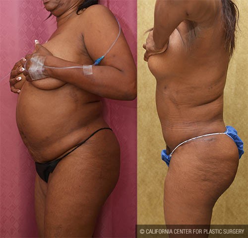 Tummy Tuck (Abdominoplasty) Small Size Before & After Patient #12842