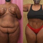 Tummy Tuck (Abdominoplasty) Plus Size Before & After Patient #12844