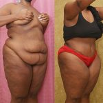 Tummy Tuck (Abdominoplasty) Plus Size Before & After Patient #12844