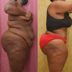 Tummy Tuck (Abdominoplasty) Plus Size Before & After Patient #12844