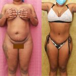 Tummy Tuck (Abdominoplasty) Small Size Before & After Patient #12877