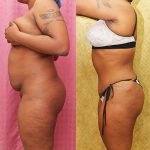 Tummy Tuck (Abdominoplasty) Small Size Before & After Patient #12877