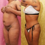 Tummy Tuck (Abdominoplasty) Small Size Before & After Patient #12877