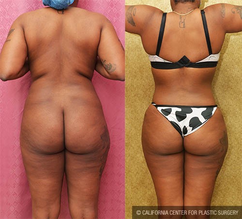 Tummy Tuck (Abdominoplasty) Small Size Before & After Patient #12877