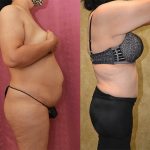 Tummy Tuck (Abdominoplasty) Medium Size Before & After Patient #12856