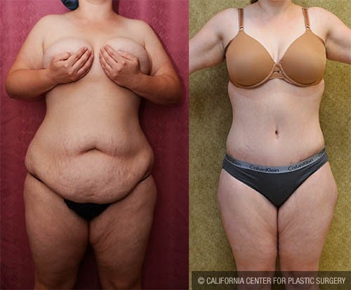 Best Tummy Tuck Before and After Photos Encino & Bakersfield