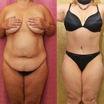 Tummy Tuck (Abdominoplasty) Medium Size Before & After Patient #12878