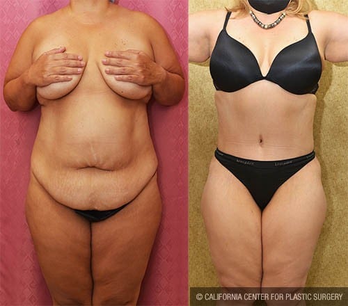 Tummy Tuck (Abdominoplasty) Medium Size Before & After Patient #12878