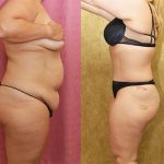 Tummy Tuck (Abdominoplasty) Medium Size Before & After Patient #12878