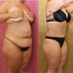 Tummy Tuck (Abdominoplasty) Medium Size Before & After Patient #12878