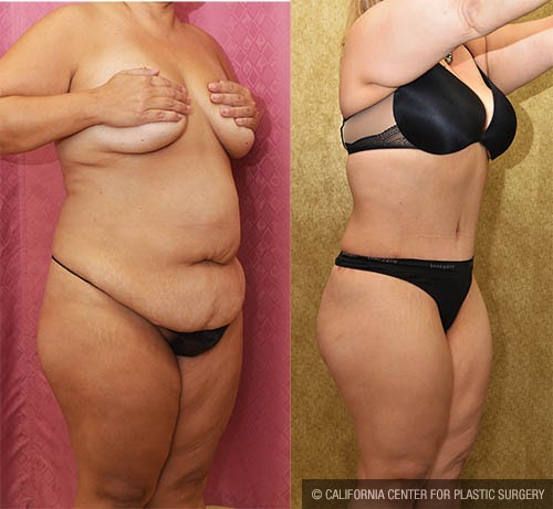 Tummy Tuck (Abdominoplasty) Medium Size Before & After Patient #12878