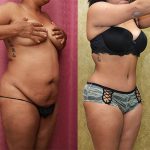 Tummy Tuck (Abdominoplasty) Small Size Before & After Patient #12827